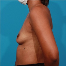 Breast Augmentation Before Photo by Michael Bogdan, MD, MBA, FACS; Grapevine, TX - Case 45787