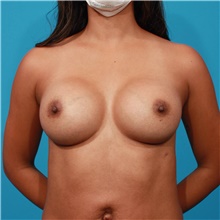 Breast Augmentation After Photo by Michael Bogdan, MD, MBA, FACS; Grapevine, TX - Case 45787