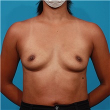 Breast Augmentation Before Photo by Michael Bogdan, MD, MBA, FACS; Grapevine, TX - Case 45787