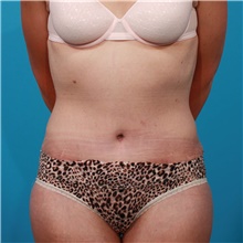 Tummy Tuck After Photo by Michael Bogdan, MD, MBA, FACS; Grapevine, TX - Case 45788