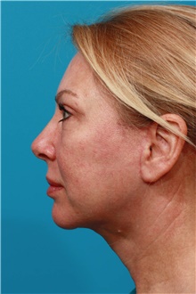 Facelift After Photo by Michael Bogdan, MD, MBA, FACS; Grapevine, TX - Case 45791