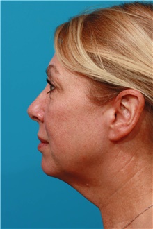 Facelift Before Photo by Michael Bogdan, MD, MBA, FACS; Grapevine, TX - Case 45791