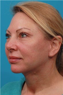 Facelift After Photo by Michael Bogdan, MD, MBA, FACS; Grapevine, TX - Case 45791