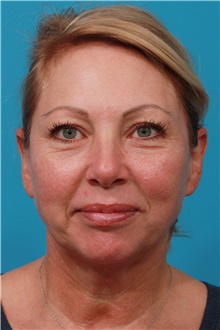 Facelift Before Photo by Michael Bogdan, MD, MBA, FACS; Grapevine, TX - Case 45791