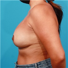 Breast Lift After Photo by Michael Bogdan, MD, MBA, FACS; Grapevine, TX - Case 45793