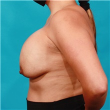 Breast Lift Before Photo by Michael Bogdan, MD, MBA, FACS; Grapevine, TX - Case 45793