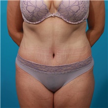 Tummy Tuck After Photo by Michael Bogdan, MD, MBA, FACS; Grapevine, TX - Case 45797