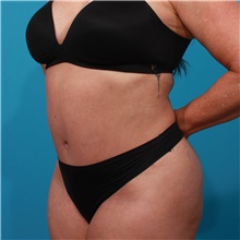 Tummy Tuck After Photo by Michael Bogdan, MD, MBA, FACS; Grapevine, TX - Case 45798