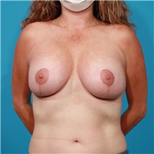 Breast Lift After Photo by Michael Bogdan, MD, MBA, FACS; Grapevine, TX - Case 46059