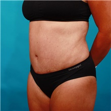 Tummy Tuck After Photo by Michael Bogdan, MD, MBA, FACS; Grapevine, TX - Case 46061