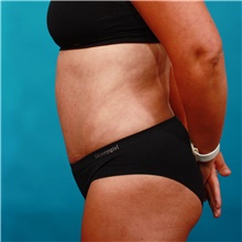 Tummy Tuck After Photo by Michael Bogdan, MD, MBA, FACS; Grapevine, TX - Case 46061