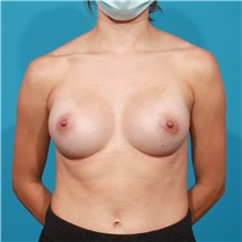 Breast Augmentation After Photo by Michael Bogdan, MD, MBA, FACS; Grapevine, TX - Case 46062
