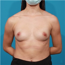 Breast Augmentation Before Photo by Michael Bogdan, MD, MBA, FACS; Grapevine, TX - Case 46062