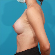 Breast Augmentation After Photo by Michael Bogdan, MD, MBA, FACS; Grapevine, TX - Case 46062