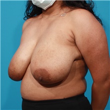 Breast Reduction Before Photo by Michael Bogdan, MD, MBA, FACS; Grapevine, TX - Case 46063