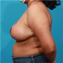 Breast Reduction After Photo by Michael Bogdan, MD, MBA, FACS; Grapevine, TX - Case 46063