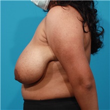 Breast Reduction Before Photo by Michael Bogdan, MD, MBA, FACS; Grapevine, TX - Case 46063