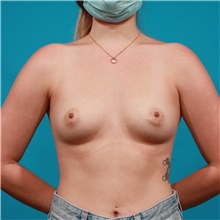 Breast Augmentation Before Photo by Michael Bogdan, MD, MBA, FACS; Grapevine, TX - Case 46066