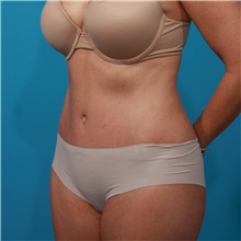 Tummy Tuck After Photo by Michael Bogdan, MD, MBA, FACS; Grapevine, TX - Case 46070