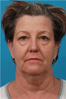 Facelift Before Photo by Michael Bogdan, MD, MBA, FACS; Grapevine, TX - Case 46072