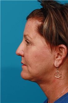 Facelift After Photo by Michael Bogdan, MD, MBA, FACS; Grapevine, TX - Case 46072