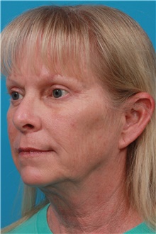 Eyelid Ptosis Repair After Photo by Michael Bogdan, MD, MBA, FACS; Grapevine, TX - Case 46073