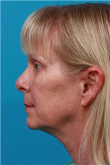 Eyelid Ptosis Repair After Photo by Michael Bogdan, MD, MBA, FACS; Grapevine, TX - Case 46073