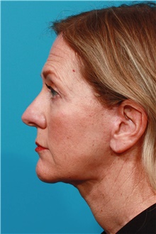 Facelift After Photo by Michael Bogdan, MD, MBA, FACS; Grapevine, TX - Case 46074