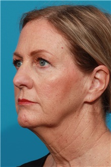 Facelift Before Photo by Michael Bogdan, MD, MBA, FACS; Grapevine, TX - Case 46074