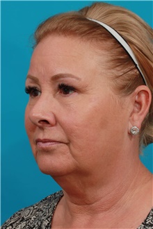 Facelift Before Photo by Michael Bogdan, MD, MBA, FACS; Grapevine, TX - Case 46075