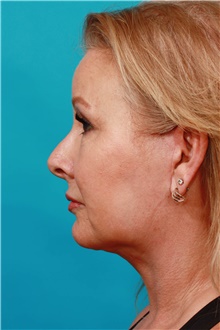 Facelift After Photo by Michael Bogdan, MD, MBA, FACS; Grapevine, TX - Case 46075