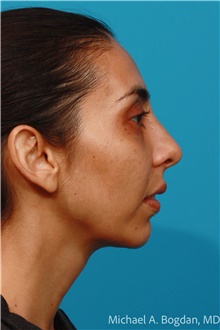 Chin Surgery After Photo by Michael Bogdan, MD, MBA, FACS; Grapevine, TX - Case 47188