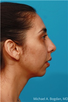 Chin Surgery Before Photo by Michael Bogdan, MD, MBA, FACS; Grapevine, TX - Case 47188