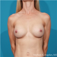 Breast Augmentation After Photo by Michael Bogdan, MD, MBA, FACS; Grapevine, TX - Case 47190