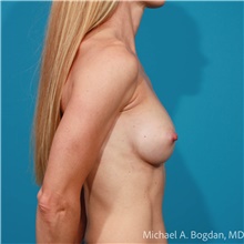 Breast Augmentation After Photo by Michael Bogdan, MD, MBA, FACS; Grapevine, TX - Case 47190