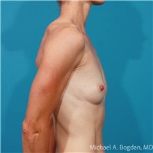 Breast Augmentation Before Photo by Michael Bogdan, MD, MBA, FACS; Grapevine, TX - Case 47190
