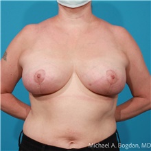 Breast Lift After Photo by Michael Bogdan, MD, MBA, FACS; Grapevine, TX - Case 47192