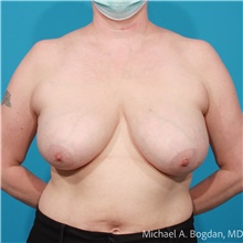 Breast Lift Before Photo by Michael Bogdan, MD, MBA, FACS; Grapevine, TX - Case 47192