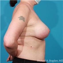 Breast Lift After Photo by Michael Bogdan, MD, MBA, FACS; Grapevine, TX - Case 47192