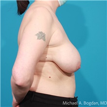 Breast Lift Before Photo by Michael Bogdan, MD, MBA, FACS; Grapevine, TX - Case 47192