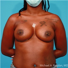 Breast Augmentation After Photo by Michael Bogdan, MD, MBA, FACS; Grapevine, TX - Case 47198