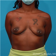Breast Augmentation Before Photo by Michael Bogdan, MD, MBA, FACS; Grapevine, TX - Case 47198