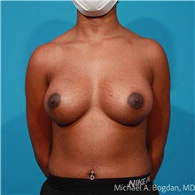 Breast Augmentation After Photo by Michael Bogdan, MD, MBA, FACS; Grapevine, TX - Case 47200