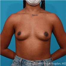 Breast Augmentation Before Photo by Michael Bogdan, MD, MBA, FACS; Grapevine, TX - Case 47200