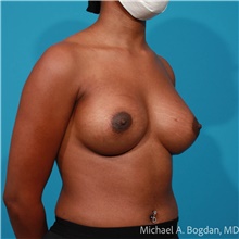 Breast Augmentation After Photo by Michael Bogdan, MD, MBA, FACS; Grapevine, TX - Case 47200