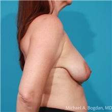 Breast Lift Before Photo by Michael Bogdan, MD, MBA, FACS; Grapevine, TX - Case 47202