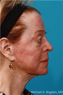 Skin rejuvenation and resurfacing After Photo by Michael Bogdan, MD, MBA, FACS; Grapevine, TX - Case 47204