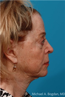 Skin rejuvenation and resurfacing Before Photo by Michael Bogdan, MD, MBA, FACS; Grapevine, TX - Case 47204