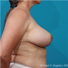 Breast Reduction After Photo by Michael Bogdan, MD, MBA, FACS; Grapevine, TX - Case 47219
