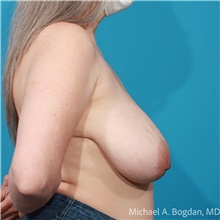 Breast Reduction Before Photo by Michael Bogdan, MD, MBA, FACS; Grapevine, TX - Case 47219